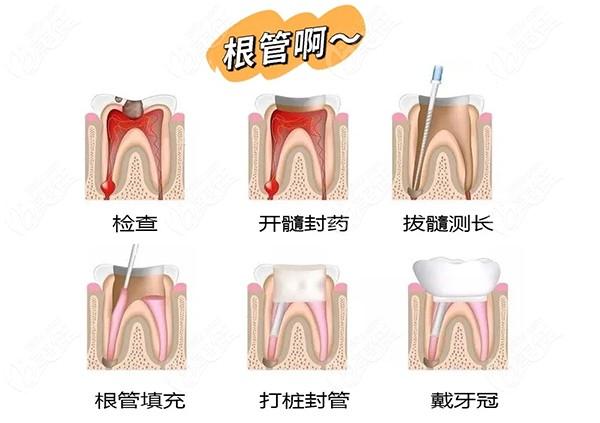 根管治療三